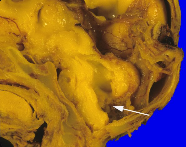 11 Dandy-Walker Deformity (Case 10) 1A