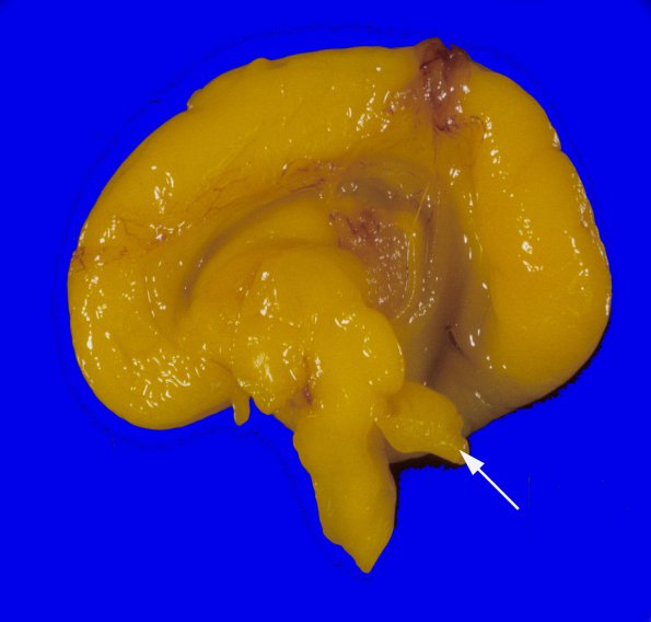 13 Dandy-Walker Malformation (Case 13) 2A