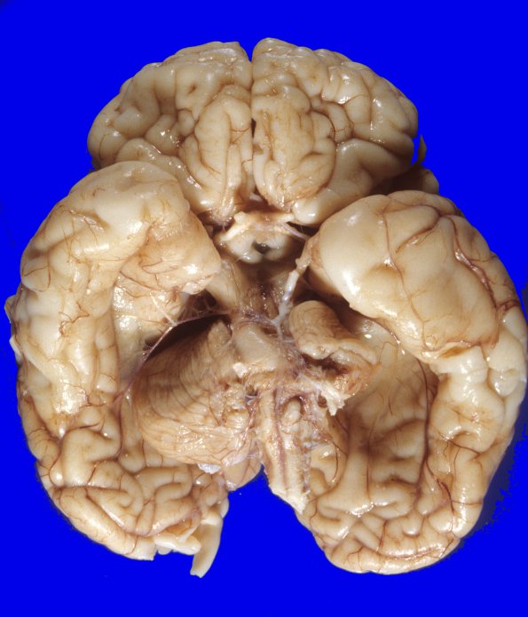 1A1 Dandy-Walker Deformity (Case 1) 1A