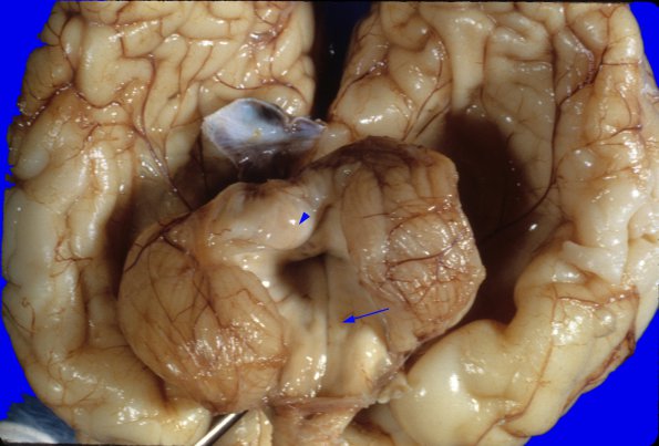 1A2 Dandy-Walker Deformity (Case 1) 3A