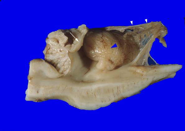 1A3 Dandy-Walker Deformity (Case 1) 2A