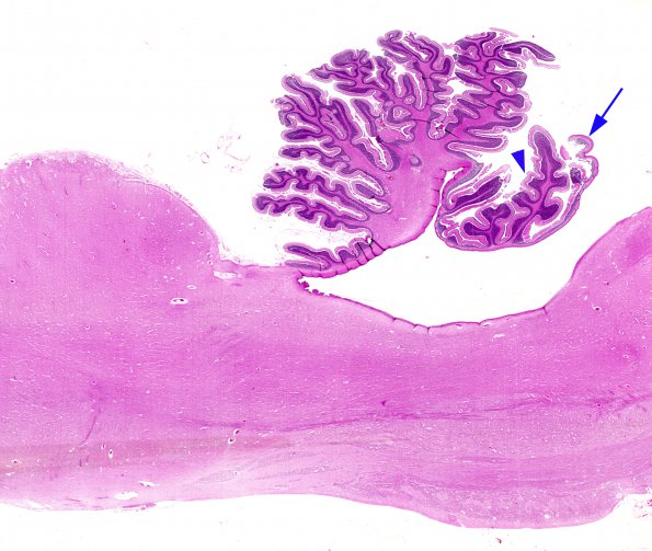 1B1 Dandy-Walker Deformity (Case 1) whole mount