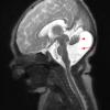 2A1 Dandy-Walker Malformation (Case 2) T2 HASTE 3