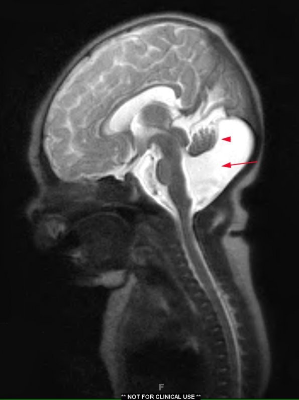 2A1 Dandy-Walker Malformation (Case 2) T2 HASTE 3