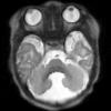 2A2 Dandy-Walker Malformation (Case 2) T2 HASTE 6