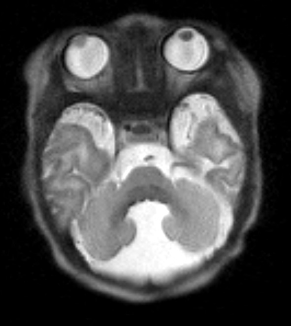 2A2 Dandy-Walker Malformation (Case 2) T2 HASTE 6