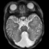 2A3 Dandy-Walker Malformation (Case 2) T2 HASTE 7