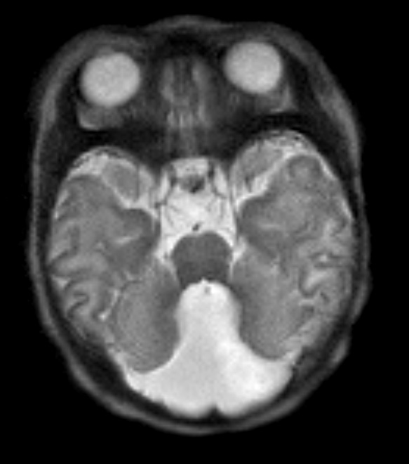 2A3 Dandy-Walker Malformation (Case 2) T2 HASTE 7