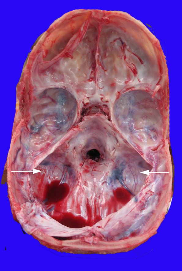 2B1 Dandy-Walker Malformation (Case 2) 24