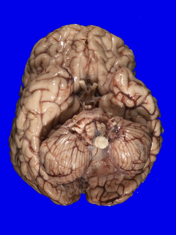 2B4 Dandy-Walker Malformation (Case 2) 4A