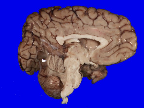 2B6 Dandy-Walker Malformation (Case 2) 12A