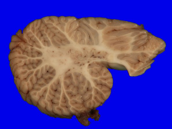 2B7 Dandy-Walker Malformation (Case 2) 18A