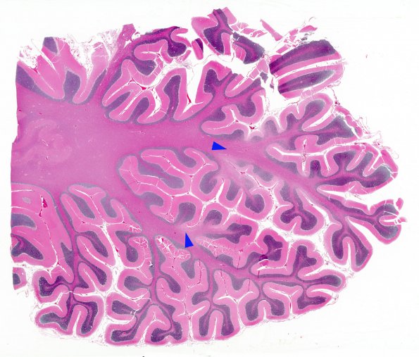 2C1 Hypoxia-Ischemia (Case 2) H&E whole mount