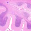 2C2 Hypoxia-Ischemia (Case 2) H&E 4