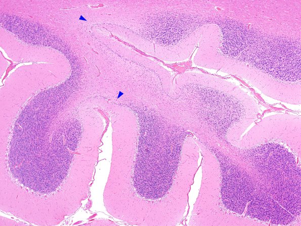 2C2 Hypoxia-Ischemia (Case 2) H&E 4