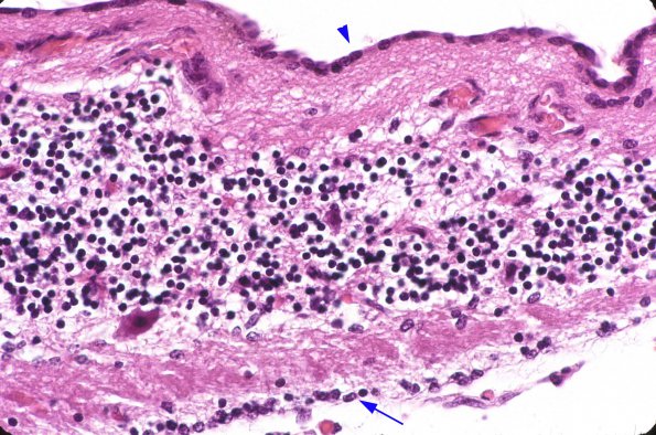 3B2 Dandy-Walker Deformity (Case 3)