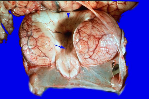 4 Dandy-Walker Deformity (Case 4C) 2AAA