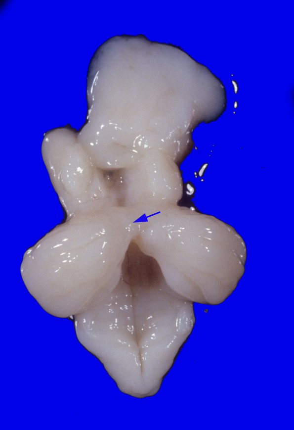 6A Dandy-Walker Malformation (Case 6) 1A