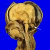 7A Dandy-Walker malformation (Case 7) 1A