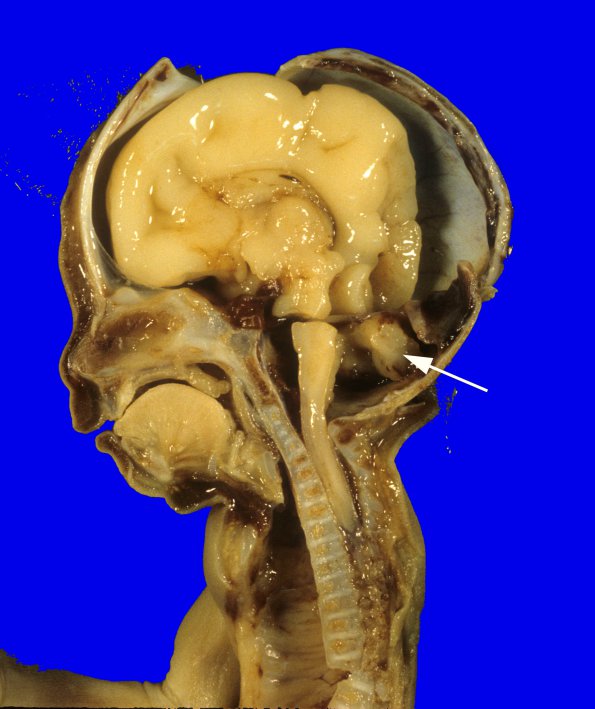 7A Dandy-Walker malformation (Case 7) 1A