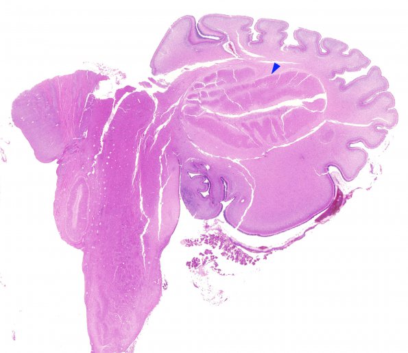 7B Dandy-Walker malformation (Case 7) 1 copy