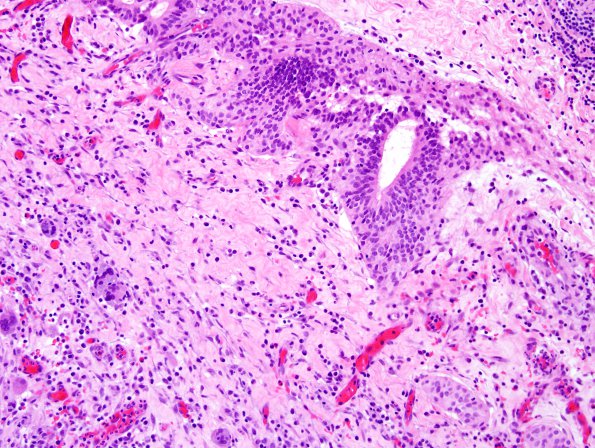 2A1 Dermal Sinus Tract (Case 2) H&E