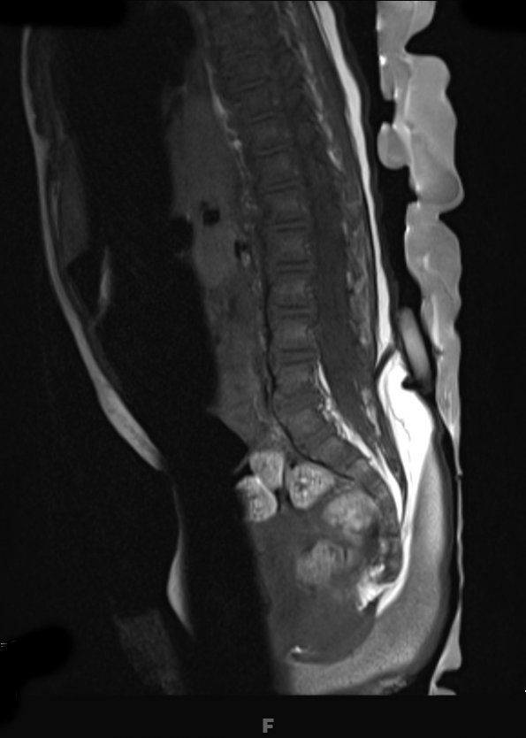 3A1 Dermal Sinus Tract (Case 3) T1 2