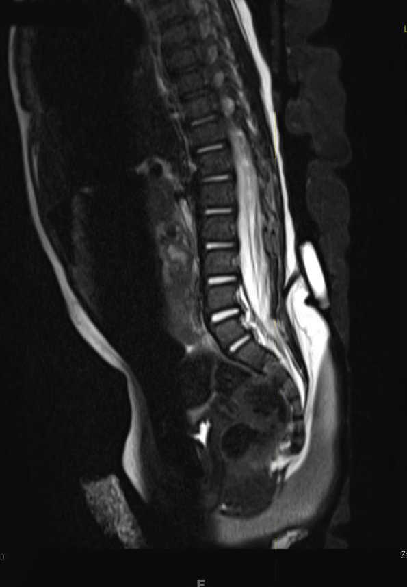 3A2 Dermal Sinus Tract (Case 3) T2 (3)