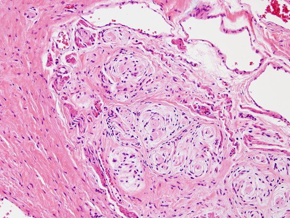 3B2 Dermal Sinus Tract (Case 3) H&E 2