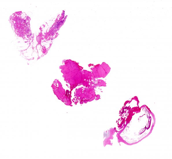 5A1 Dermal Sinus-Cyst, nasal, intracranial (Case 5) H&E whole mount A