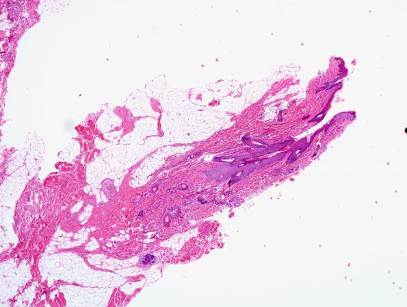 5A2 Dermal Sinus-Cyst, nasal, intracranial (Case 5) H&E 2