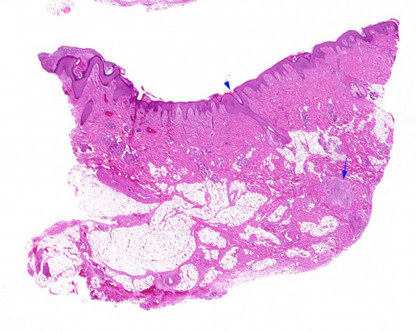 6A1 Skin ectopic tethered cord (Case 6) b