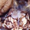 1 Chordoma vs ecchordosis physaliphora (source unknown)