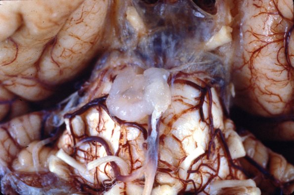 1 Chordoma vs ecchordosis physaliphora (source unknown)