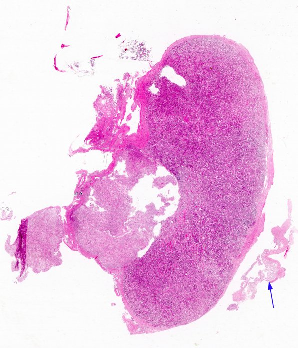 2A1 Ecchordosis physaliphora, adjacent to pituitary (Case 1) H&E whole mount