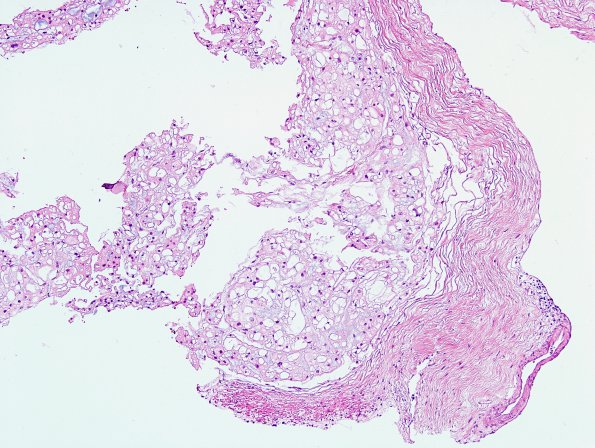 2A2 Ecchordosis physaliphora, adjacent to pituitary (Case 1) H&E 3