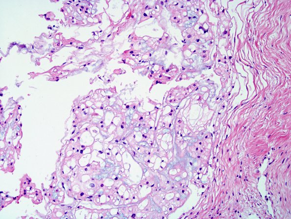 2A3 Ecchordosis physaliphora, adjacent to pituitary (Case 1) H&E 4