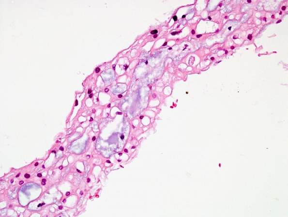 2A4 Ecchordosis physaliphora, adjacent to pituitary (Case 1) H&E 1