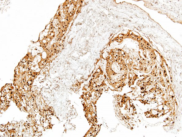 2B1 Ecchordosis physaliphora (Case 1) Brachyury 10X