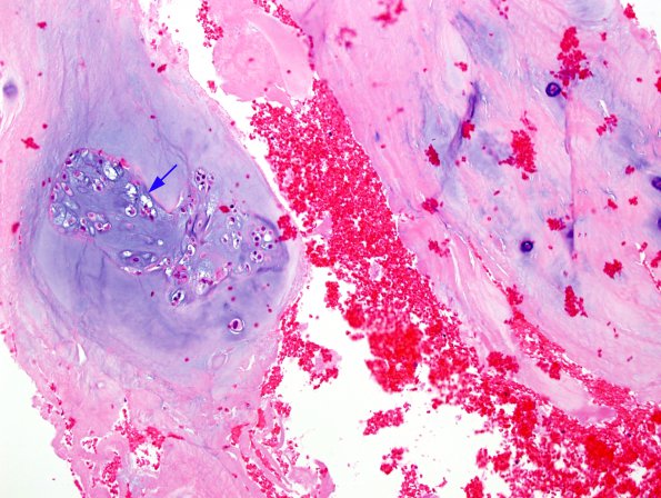 3A1 Notochord remnant, minute, in degenerated disc material (Case 2)-H&E-4