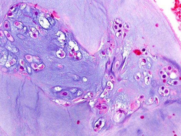 3A2 Notochord remnant, minute, in degenerated disc material (Case 2)-H&E-1