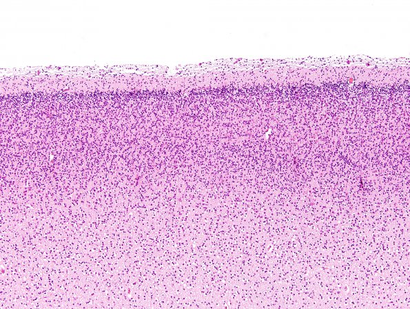 1A1 Ectopic Neurons, cortical layer 1 (Case 1) H&E 4