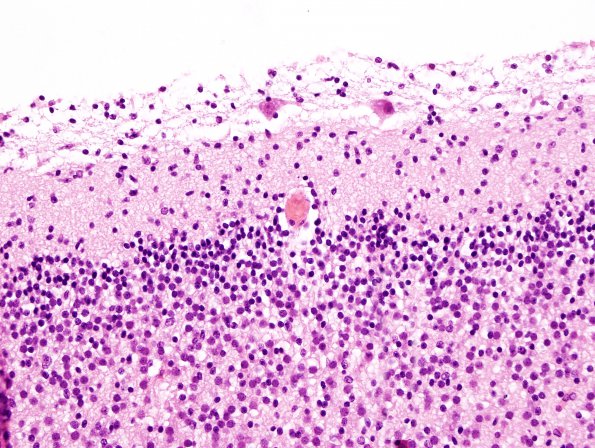 1A2 Ectopic Neurons, cortical layer 1 (Case 1) H&E 3