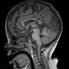 1A1 Empty Sella Syndrome (Case 1) T1 SAG 3 copy