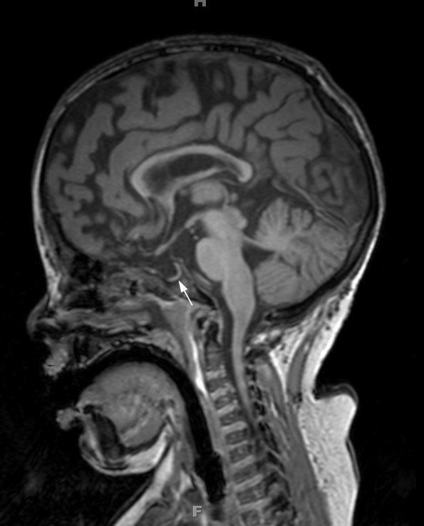 1A1 Empty Sella Syndrome (Case 1) T1 SAG 3 copy