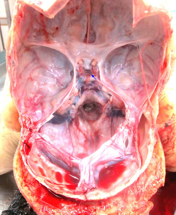 1B Empty Sella Syndrome (Case 1) 1A_2 copy