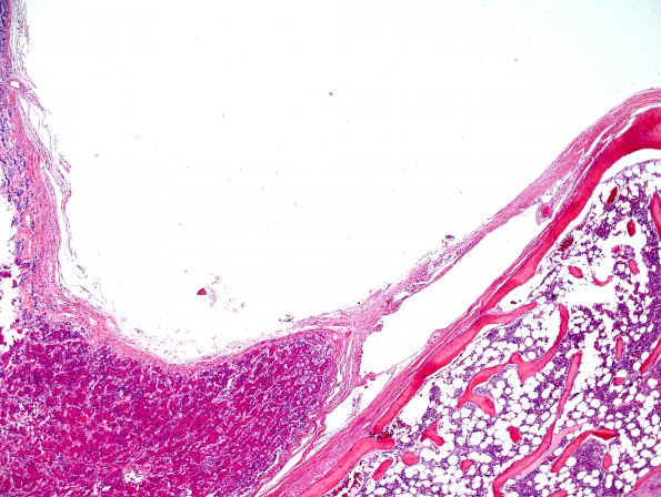 1C2 Empty Sella Syndrome (Case 1) H&E 1.jpg