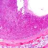 1C3 Empty Sella Syndrome (Case 1) H&E 2.jpg