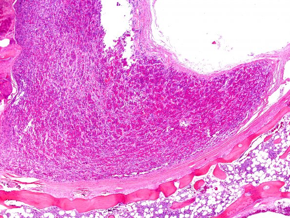 1C3 Empty Sella Syndrome (Case 1) H&E 2.jpg