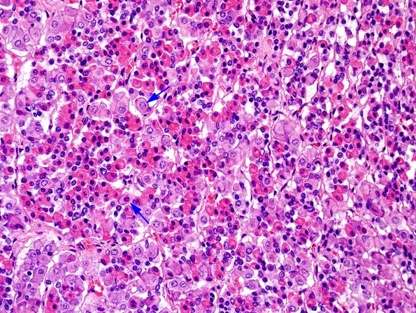 1D1 Empty Sella Syndrome (Case 1) Crooke's change H&E 3 copy.jpg